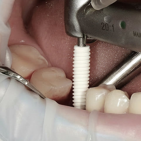 3Dresyn OD BCI1 MF Bio Biocompatible Dental Implant Resin