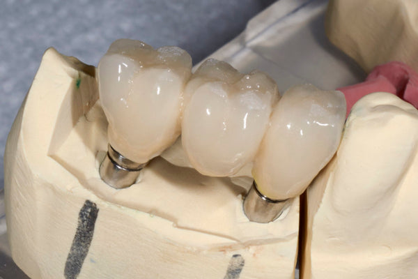 3Dresyn IJ OD C&B for durable "Crowns & Bridges" with tooth colors