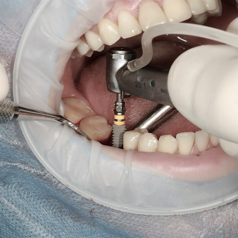 3Dresyn OD BCI1 MF Bio for printing monomer free BioComposite Dental Implants