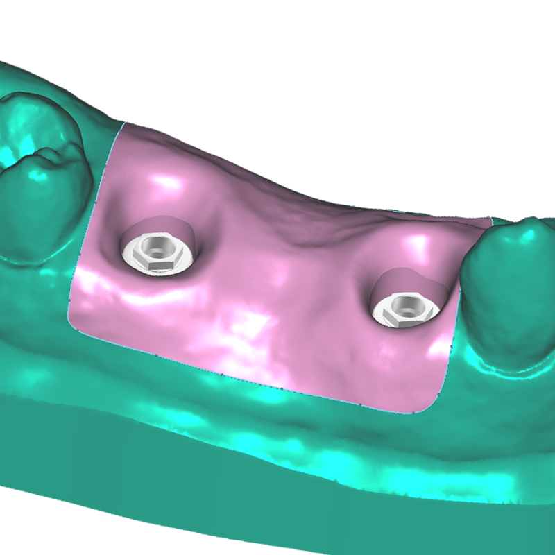 3Dresyn OD S Soft, pink gingiva color for printing gingiva masks on implant models