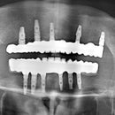 3Dresyn OD Try-In white radio opaque